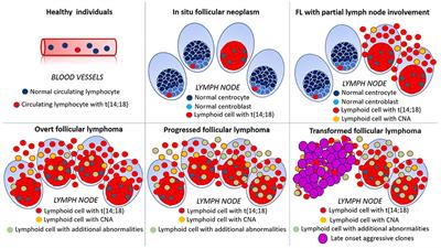 Unraveling Tumor Heterogeneity in an Apparently Monolithic Disease: BCL2 and Other Players in the Genetic Landscape of Nodal Follicular Lymphoma